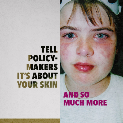 Close up of a girls face with skin condition, and text that reads "Tell policy-makers its about your skin and so much more"